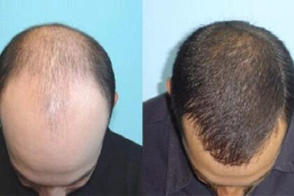 People's health is being played with in the name of removing baldness