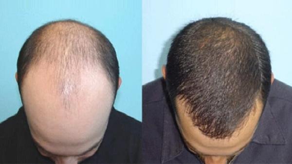 People's health is being played with in the name of removing baldness